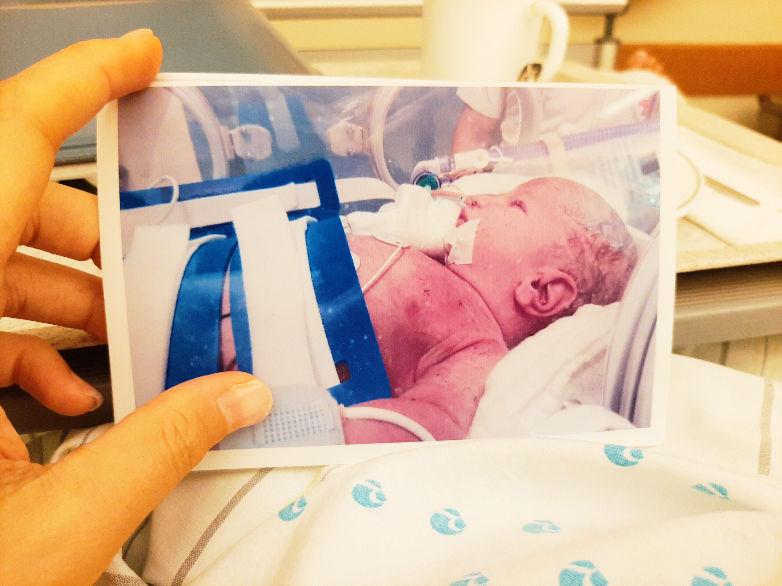 Mutter hält ein Foto ihres Sohnes im Inkubator in den Händen. Das Kind ist an Schläuche angeschlossen und hat blaue Flecken von der Geburt